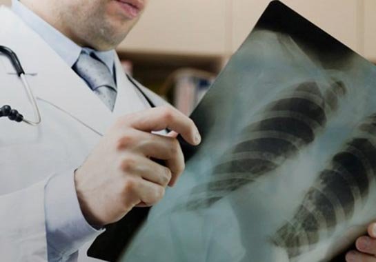 Conhecendo a Pneumonia