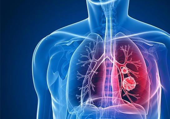 Tuberculose: Conheça os diferentes tipos de tuberculose
