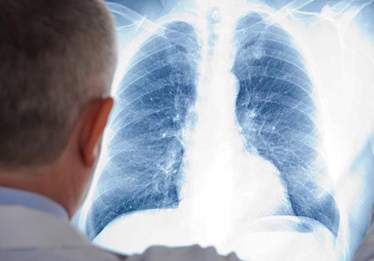 Médico olhando para radiografia do pulmão - Clínica do Pulmão